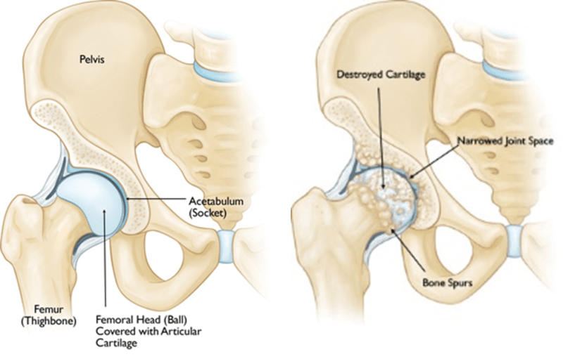 3-HEALTHY HIP-ARTHRITIC HIP.png